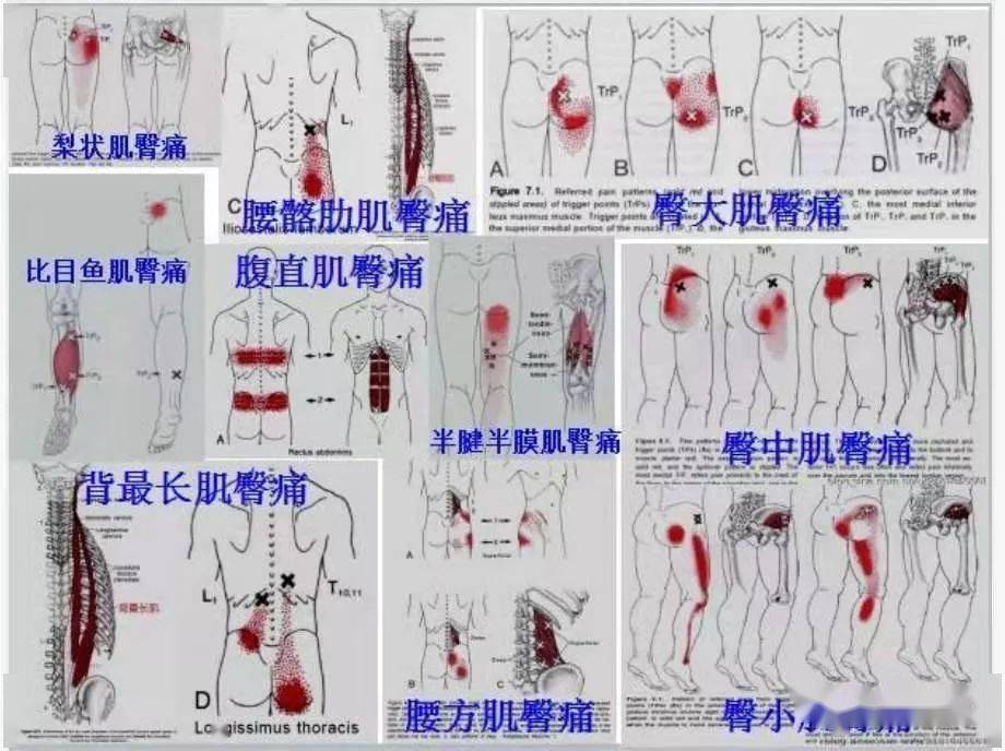 肌筋膜全身160个疼痛触发点