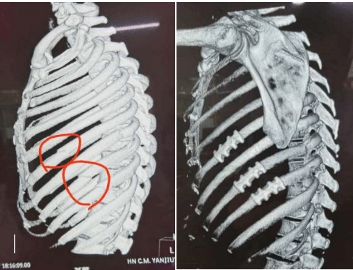 右侧第九肋骨骨折图片图片