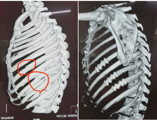 肋骨骨皮质断裂图片图片