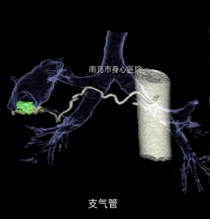 支气管血管ct成像检查适应症:支气管扩张,支气管动脉瘤,肺癌,肺内转移