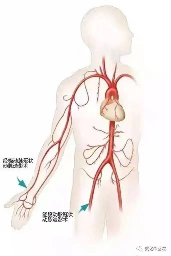 冠状动脉造影报告单图片