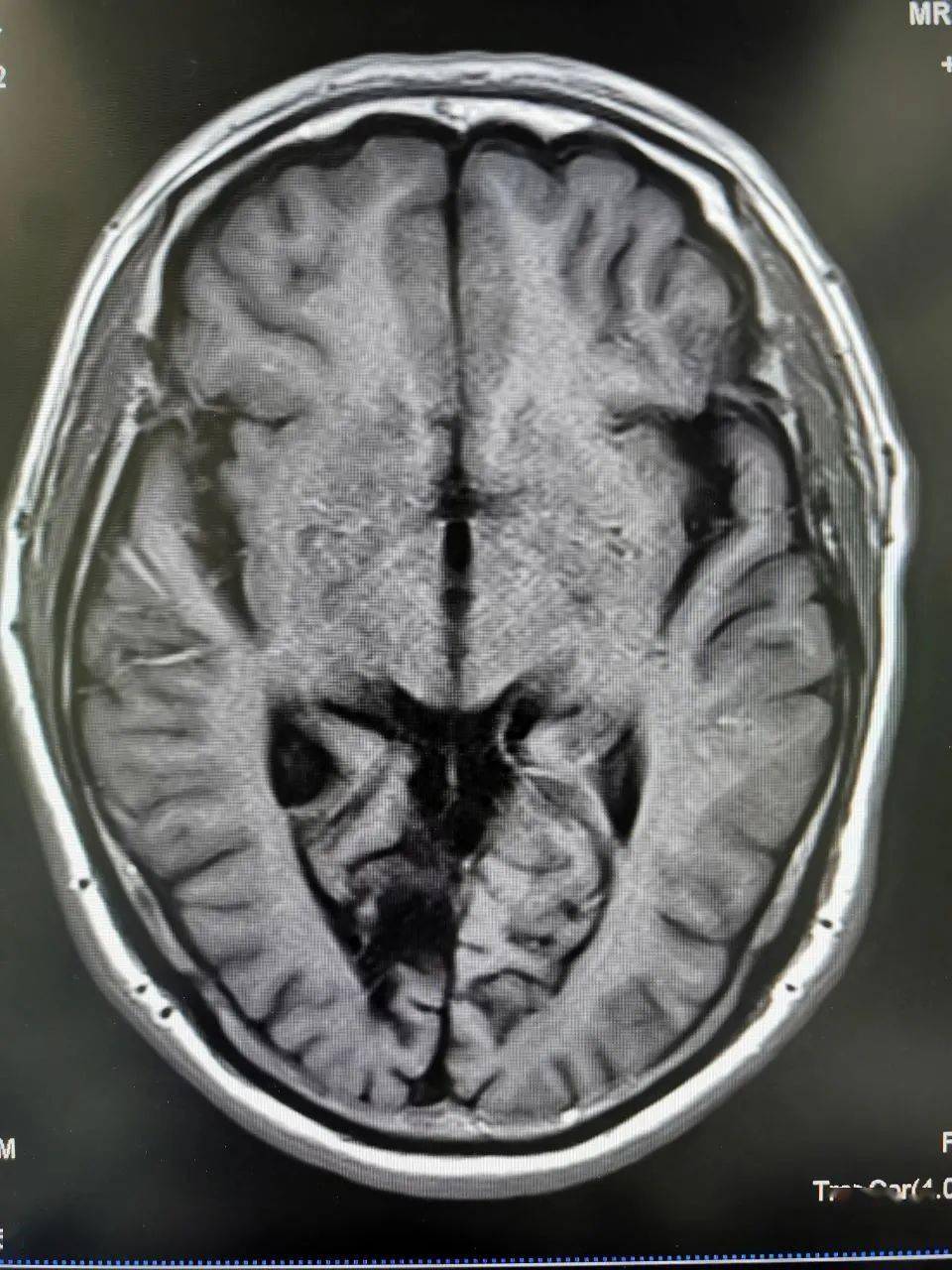 右側枕葉見大片狀t1wi低,t2wi高信號影10dwi(b=1000)未見異常高信號影