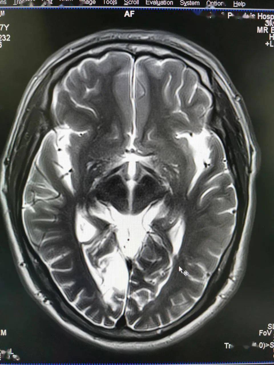 业务视窗丨磁共振新技术asl之应用脑梗死诊断