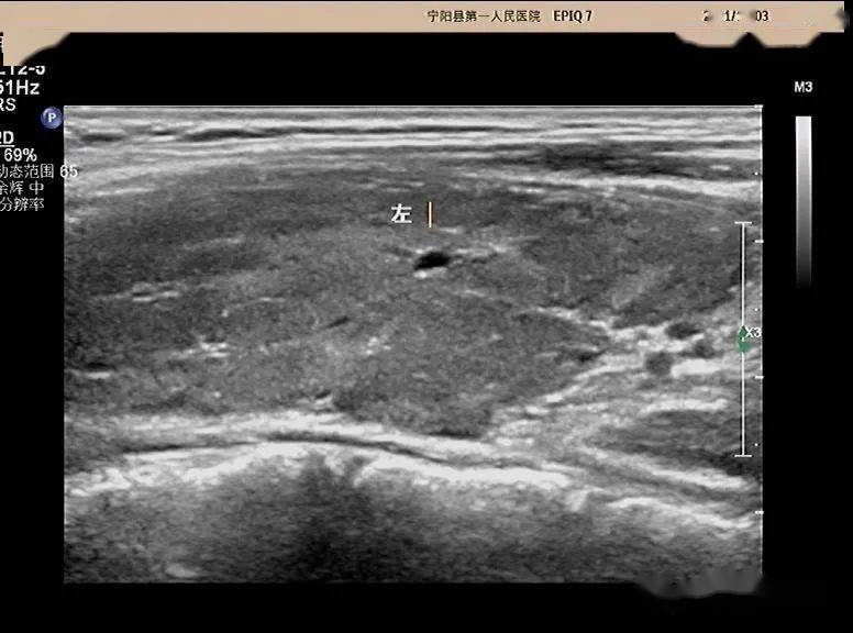 超声问答61这个颈部淋巴结应该如何考虑?