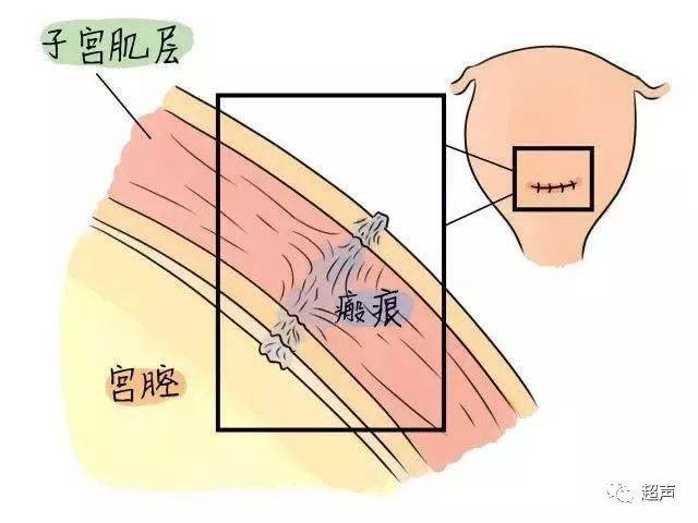 化,因為子宮下段的測量部位無法統一,而測量還受膀胱充盈程度等影響