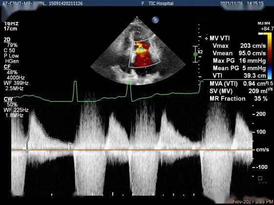贞心一课风湿性心脏病合并瓣叶脱垂teer治疗1例