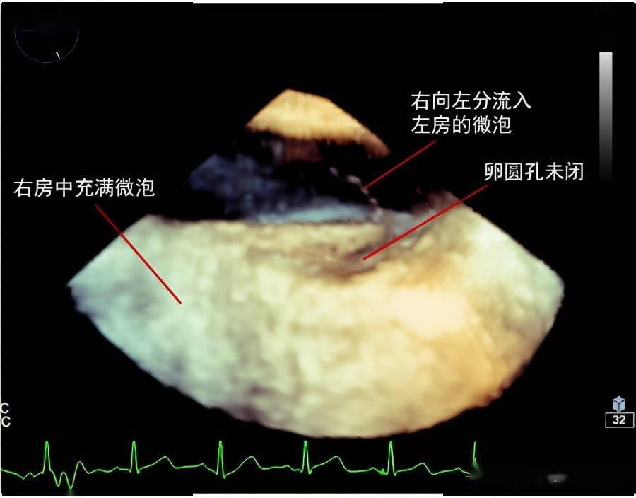 原来是心脏卵圆孔未闭 协和金银湖院区小儿无痛经食管超声心动图精 确