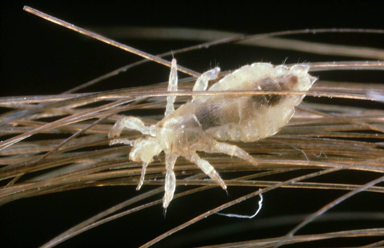 30年前，虱子在男女老少头上很常见，为啥忽然间消失了？_搜狐网, image size:1280x828