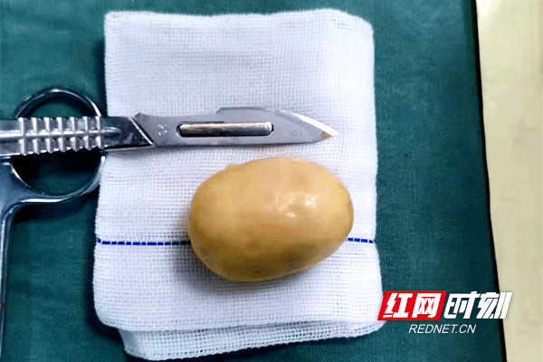 肠梗阻|隆回：患者腹痛突发“肠梗阻”，腹内取出“黄宝石”