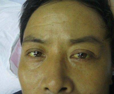 眼睛变黄可能是黄疸性肝炎或淤积性肝炎, 因此建议到医院检查