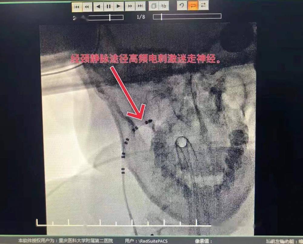 重医二院聚焦前沿第73期靶向消融心脏迷走神经缓慢性心律失常患者的新