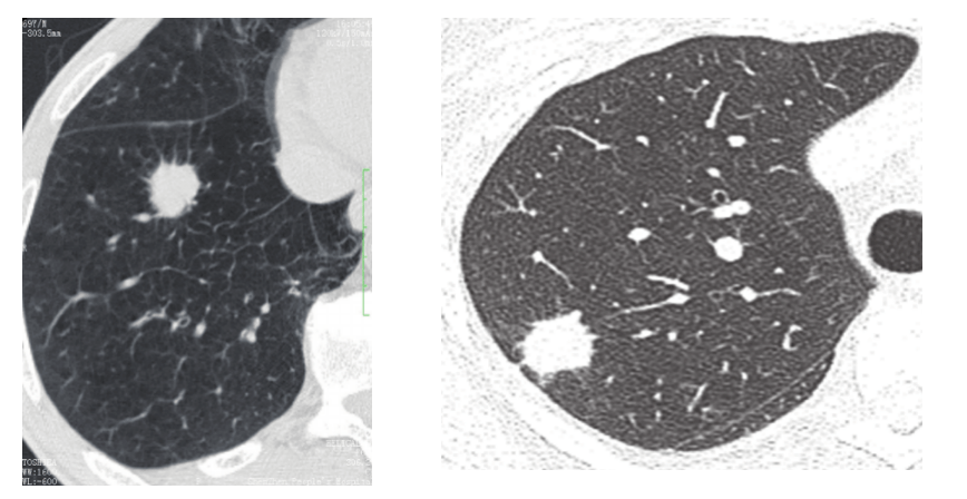 棘状突起:肿瘤细胞局部浸润,是介于分叶和毛刺之间粗钝的杵状结构2.