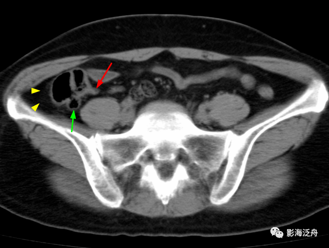 阑尾炎b超图片 报告单图片