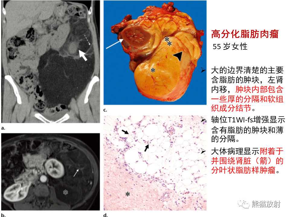 省立影像讀片腹膜後腫瘤2112