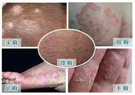 大腿根部两侧发黑还很痒 原来是得了这种病 真菌 患者 部位