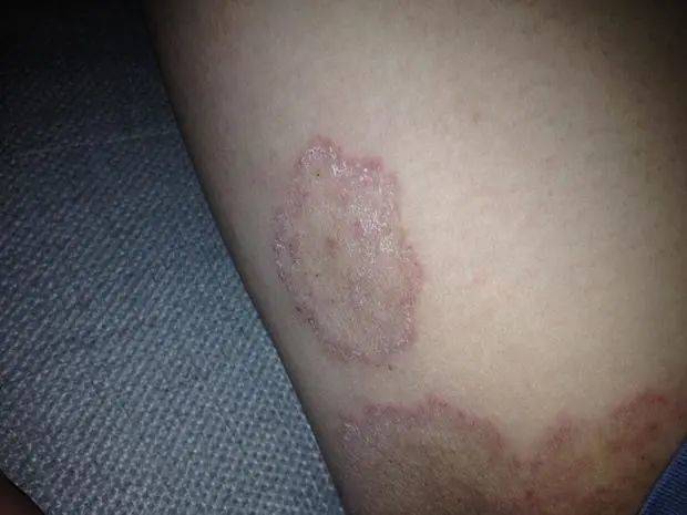 大腿根部两侧发黑还很痒？原来是得了这种病.....