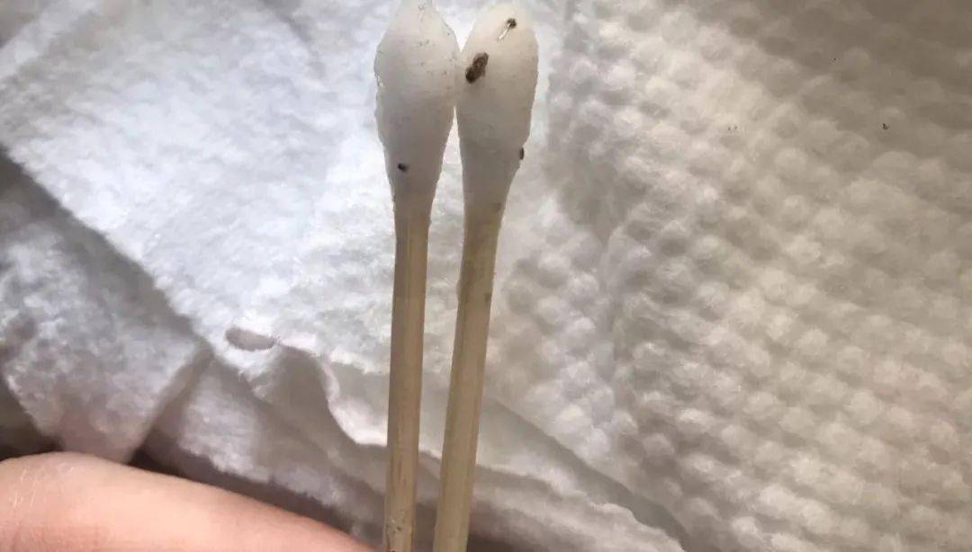眼睛别再用针挑了！用它，脂肪粒自己“掉”下来，比医美效果还赞！