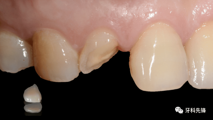 【病例】上前牙冠折修复_照片_牙齿_粘结