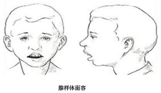 呼吸,致使面骨發育發生障礙,頜骨變長,顎骨高拱,牙列不齊,上切牙突出