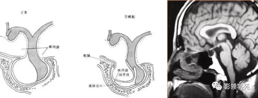 Rathke|垂体解剖及常见病变影像学表现