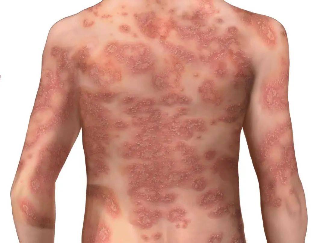 表现为红斑及正常皮肤基础上播散性无菌性脓疱.脓包型银屑病no.