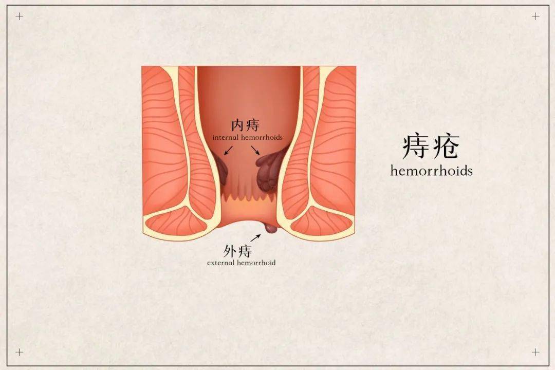 鲜血|一顿火锅后，厦门女子上厕所全是血！一查已重度...医生：这病一定要重视！