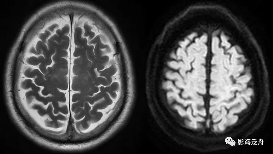 诊断|颅脑MR平扫中极易漏诊的点