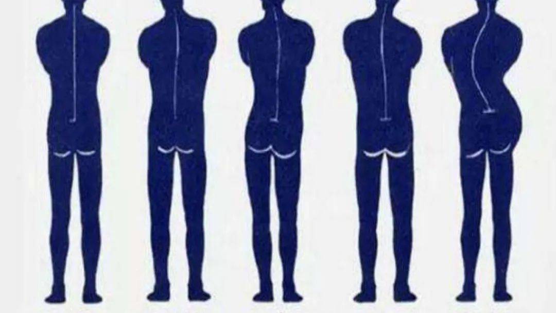 人体脊柱侧面曲线图片
