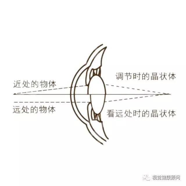 散瞳是應用藥物使眼睛的睫狀肌完全麻痺,使眼睛在失去調節作用的情況