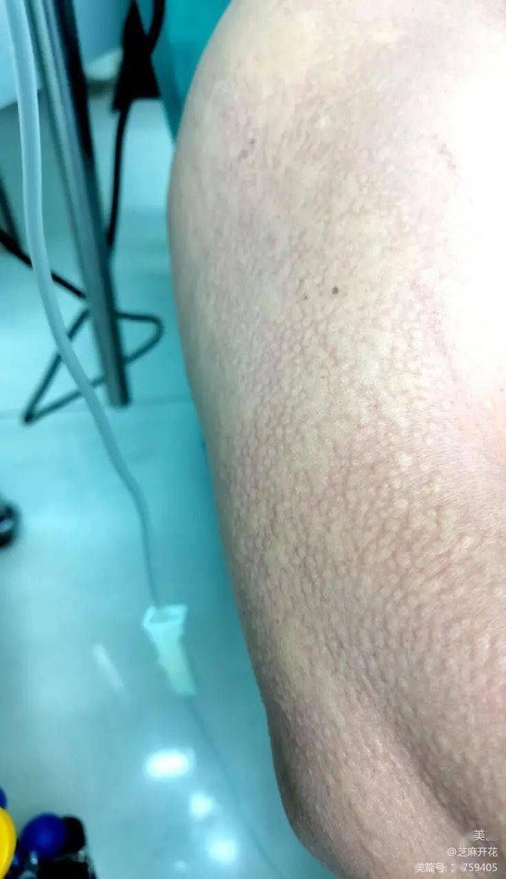 堪比教科书ct增强扫描碘对比剂中度过敏一例的抢救与经验总结