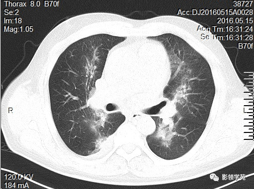 肺水肿绘图图片