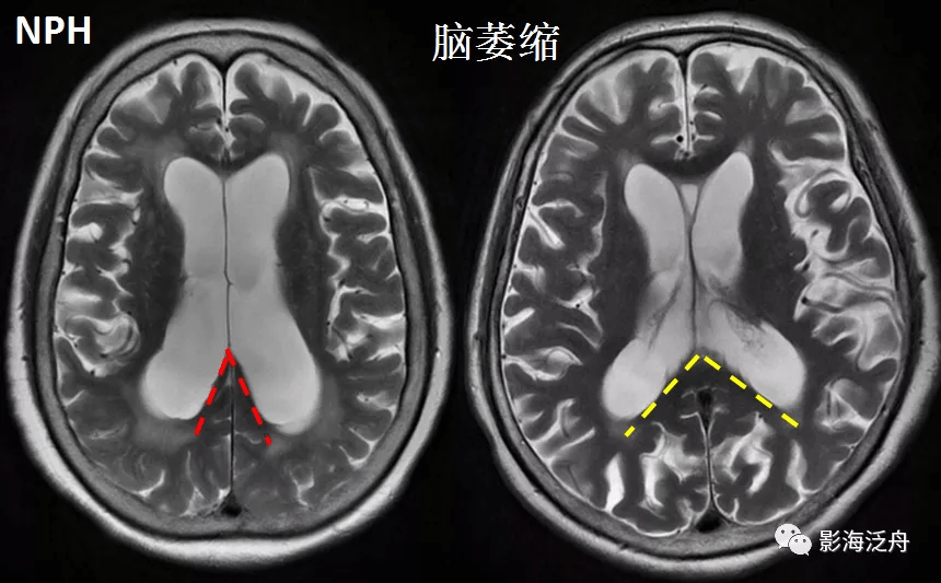 诊断|小心误诊，这可不是单纯的脑萎缩