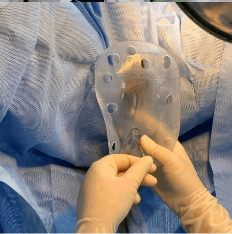 浙南唯一三维后装放疗中心是晚期宫颈癌患者的希望