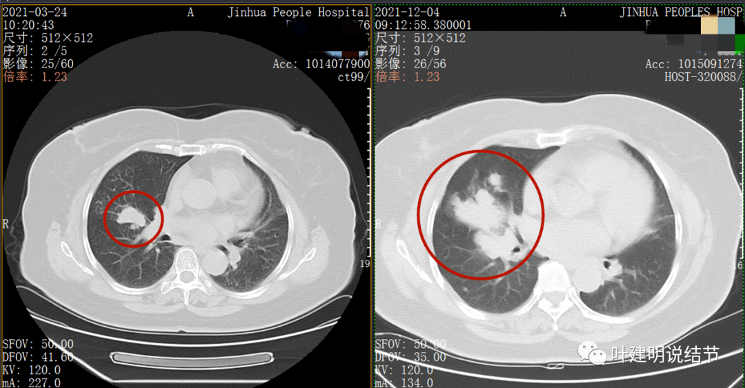 肺癌卫星结节图片