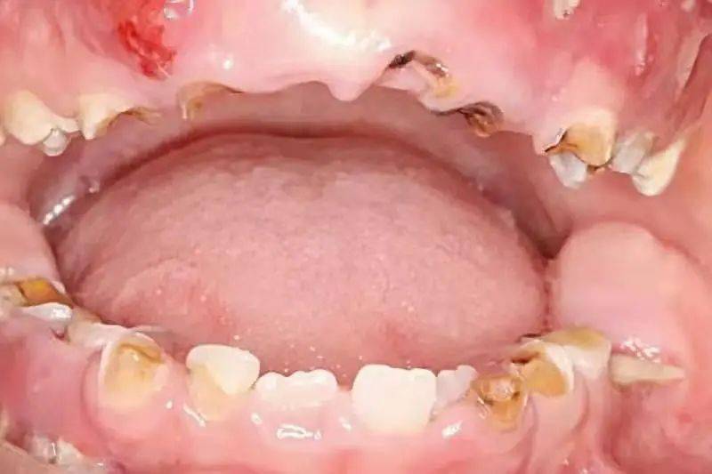 蒙自市中医医院口腔科迎新年惠民活动开始啦_乳牙_牙齿_进行