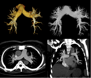 肺动脉cta逐层图解图片