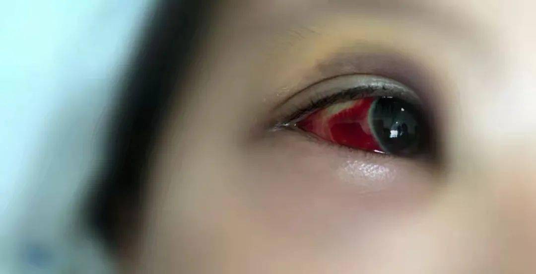 有孩子咳到眼睛出血住进icu注意近期百日咳病人反常增多