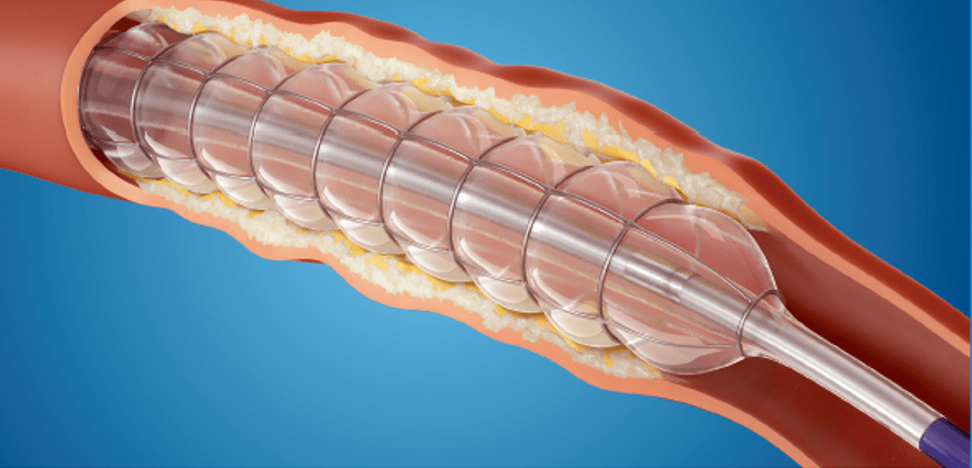 宁波华美血管外科团队探索弓上动脉病变腔内微创治疗新模式巧克力球囊