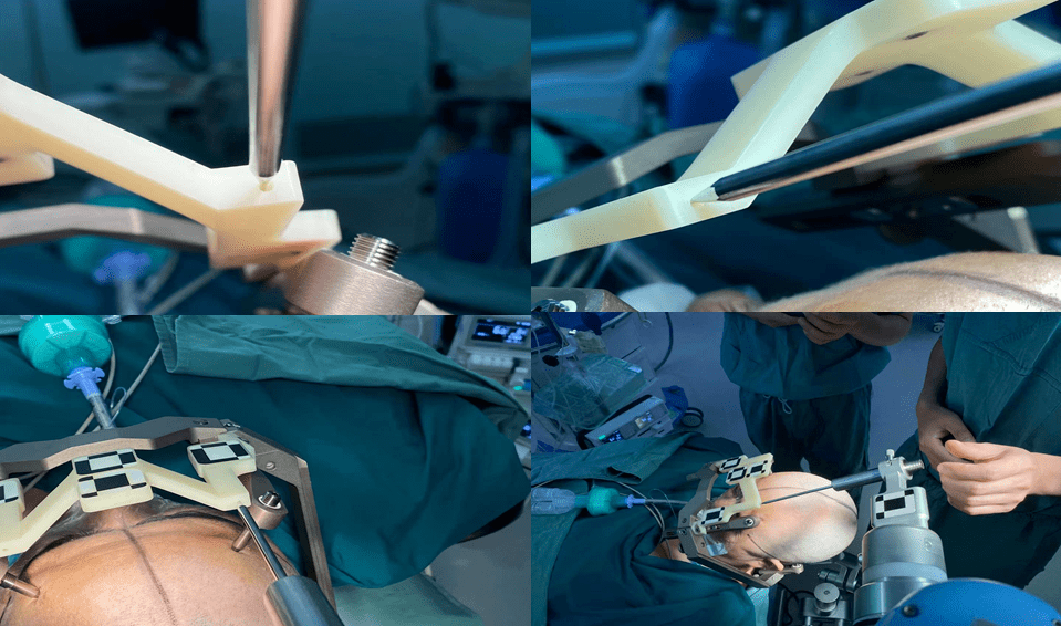 睿米特约专访南京鼓楼医院徐武机器人辅助dbs手术治疗梅杰综合征如何