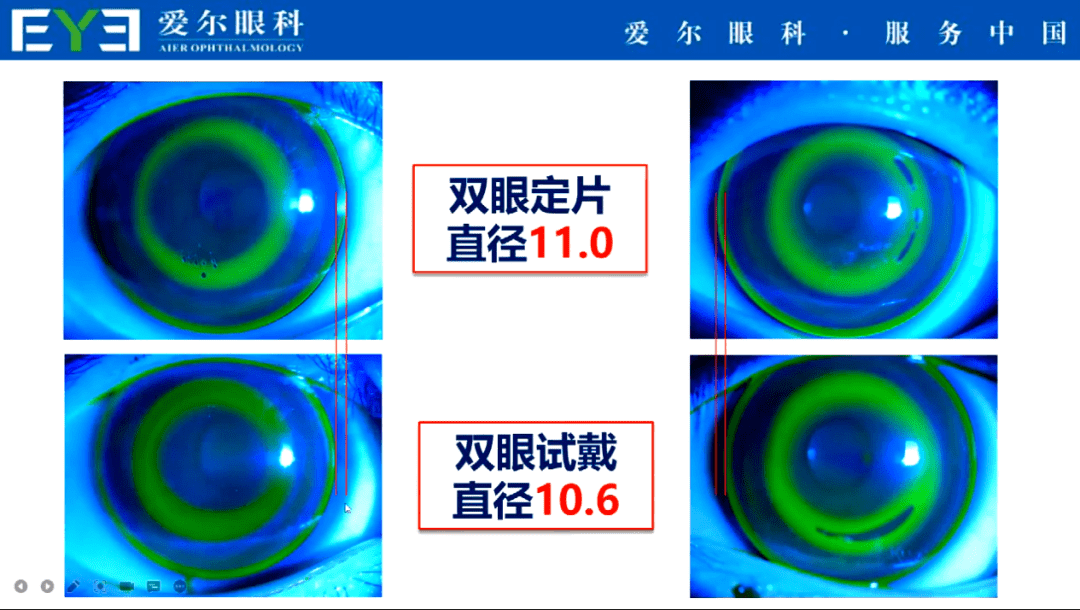 爱尔眼科对比阿玛施图片