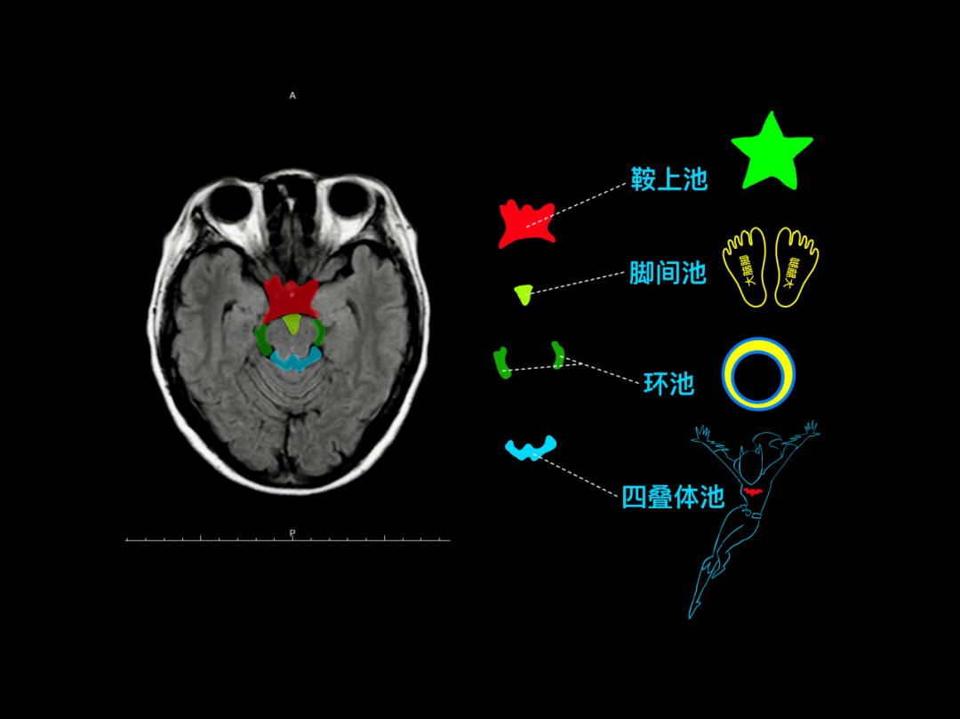 超棒颅脑mr阅片手绘版来啦