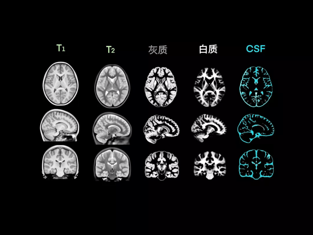 冠狀位顳葉解剖中腦,大腦腳視覺傳導通路腦