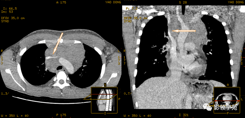 胸壁肌肉CT图片