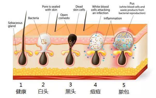 因为粉刺痘痘能挤吗？