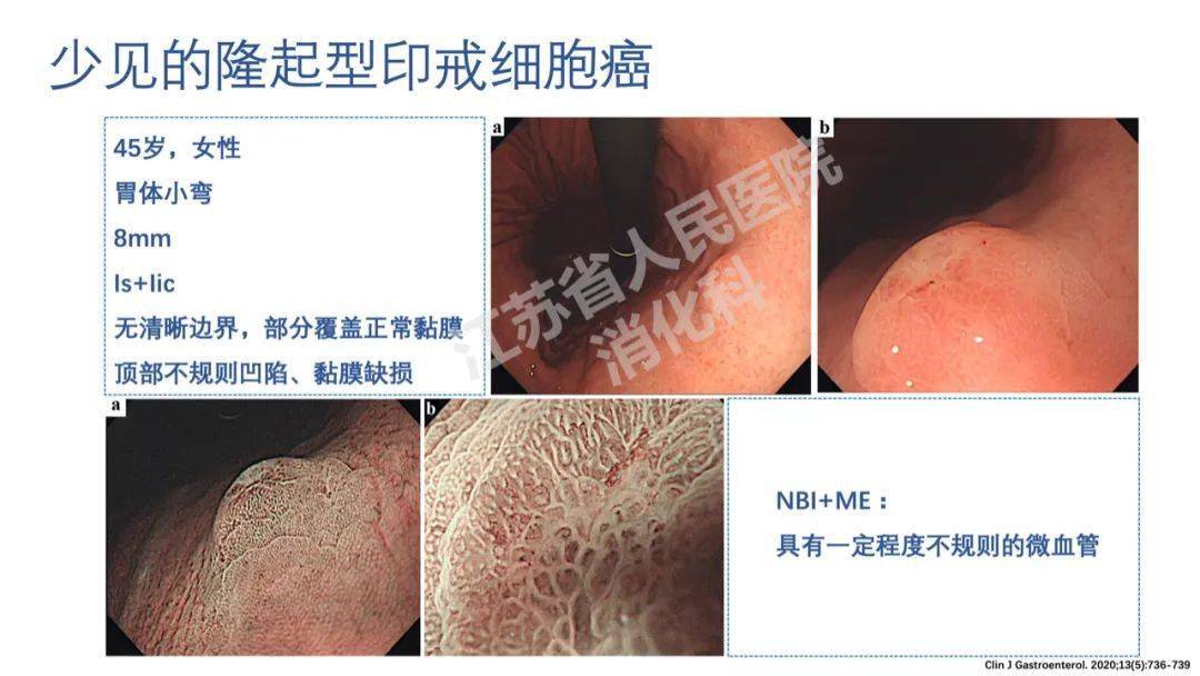 早癌沙龍王雲副主任醫師幽門螺桿菌未感染早期胃癌內鏡特徵