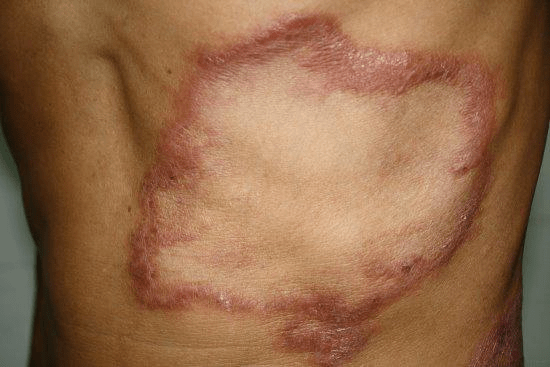 关于麻风病你了解多少