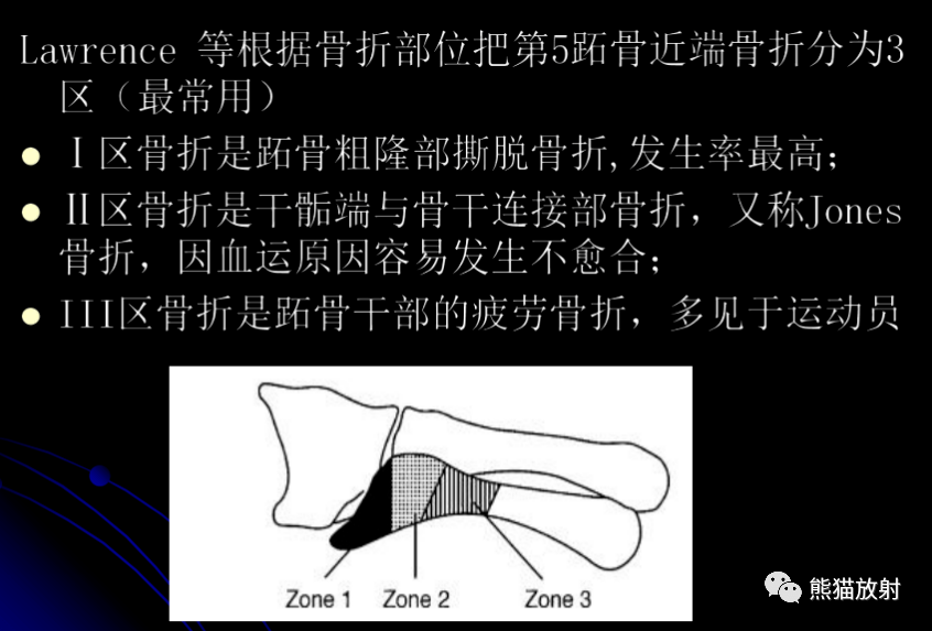 第五跖骨基底部骨折丨表现分型鉴别