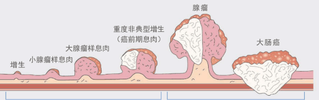癌变_复查_治疗