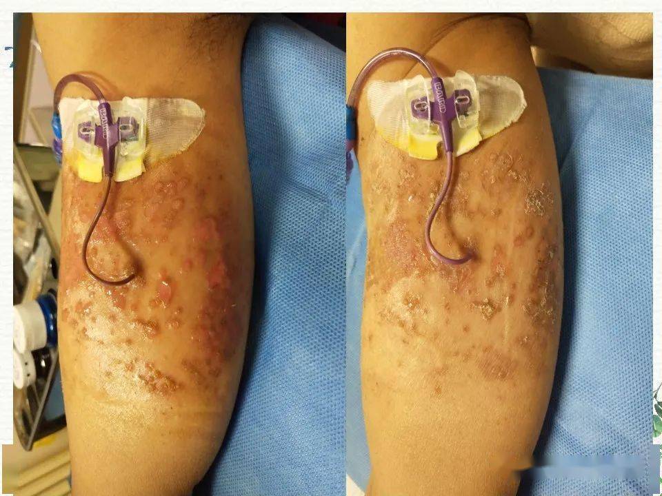 pptpicc的护理常规及冲封管流程