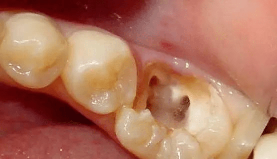 牙髓炎的症状下颚图片